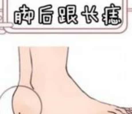 脚踝长颗痣的含义