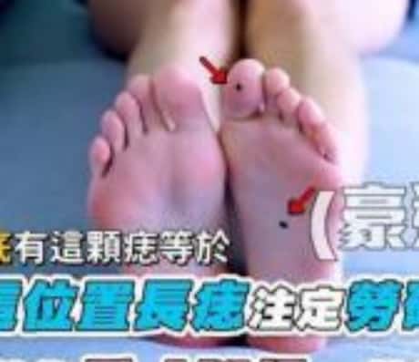 脚背长痣，如何科学应对？