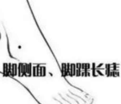 脚踝上长痣的含义与解读