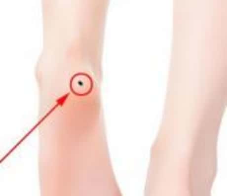 脚踝长了颗痣，这是怎么回事？